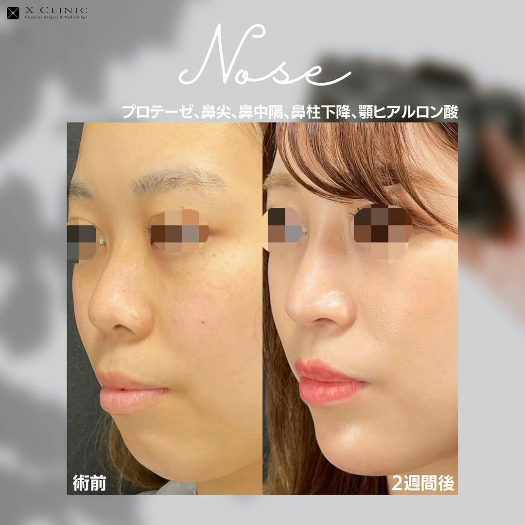 【女性・鼻】プロテーゼ、鼻尖、鼻中隔、鼻柱下降、顎ヒアルロン酸_before_aftar