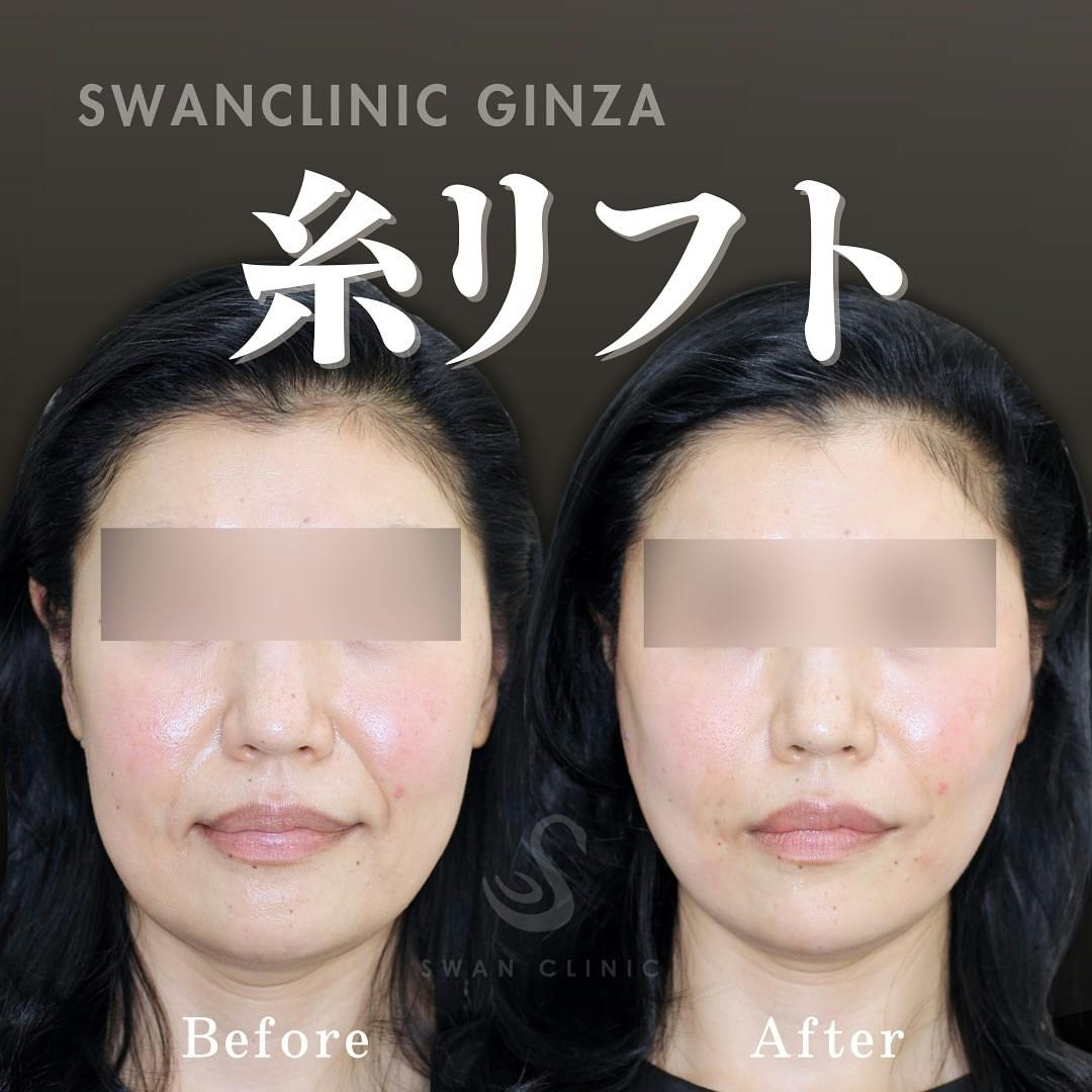 【女性・法令線】法令線とフェイスラインの糸リフト複合治療_before_aftar