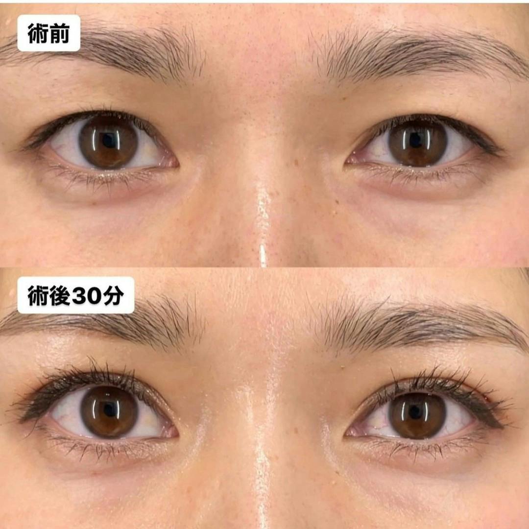 【女性・目元】Xクロスダブル_before_aftar