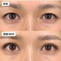 【女性・目元】Xクロスダブル_before_aftar