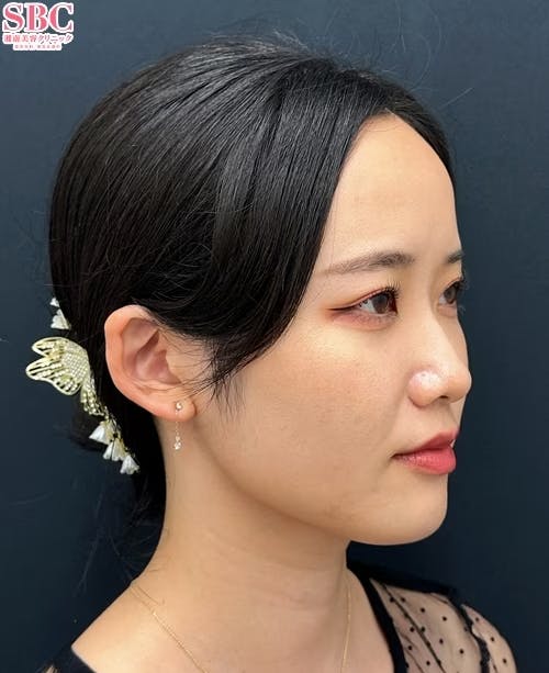 【20代女性・顔】Aquicell(アキーセル)脂肪吸引・根こそぎVASER脂肪吸引・エンブレイスRF・糸リフト_after