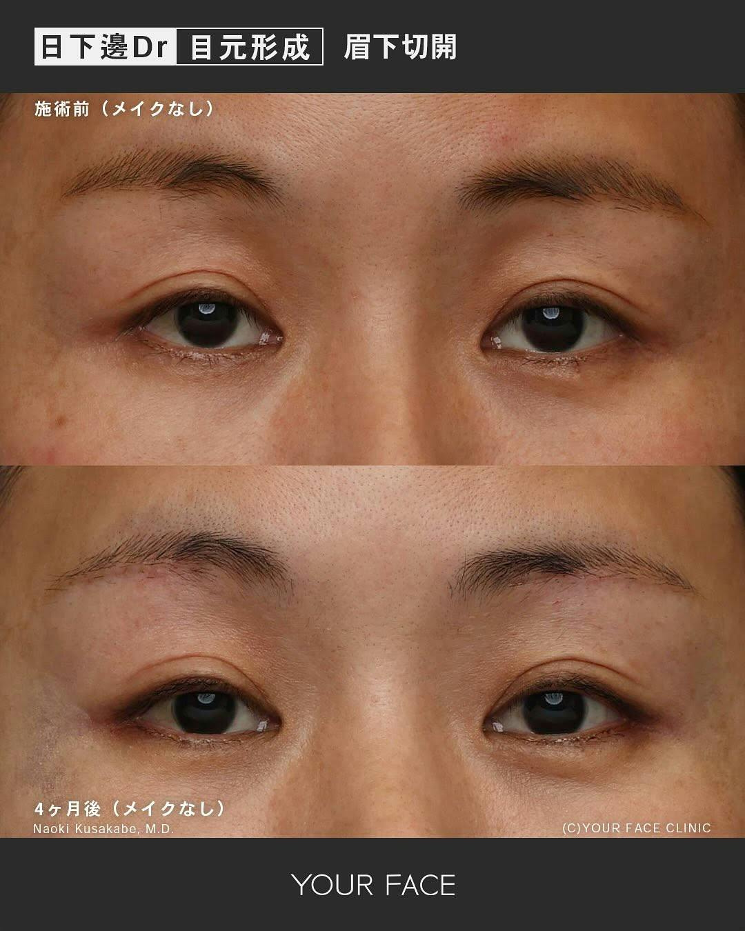 【女性・たるみ】眉下切開_before_aftar