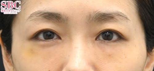 【女性・目元】裏ハムラ法、ナチュラル脂肪注射ナノリッチ_1week