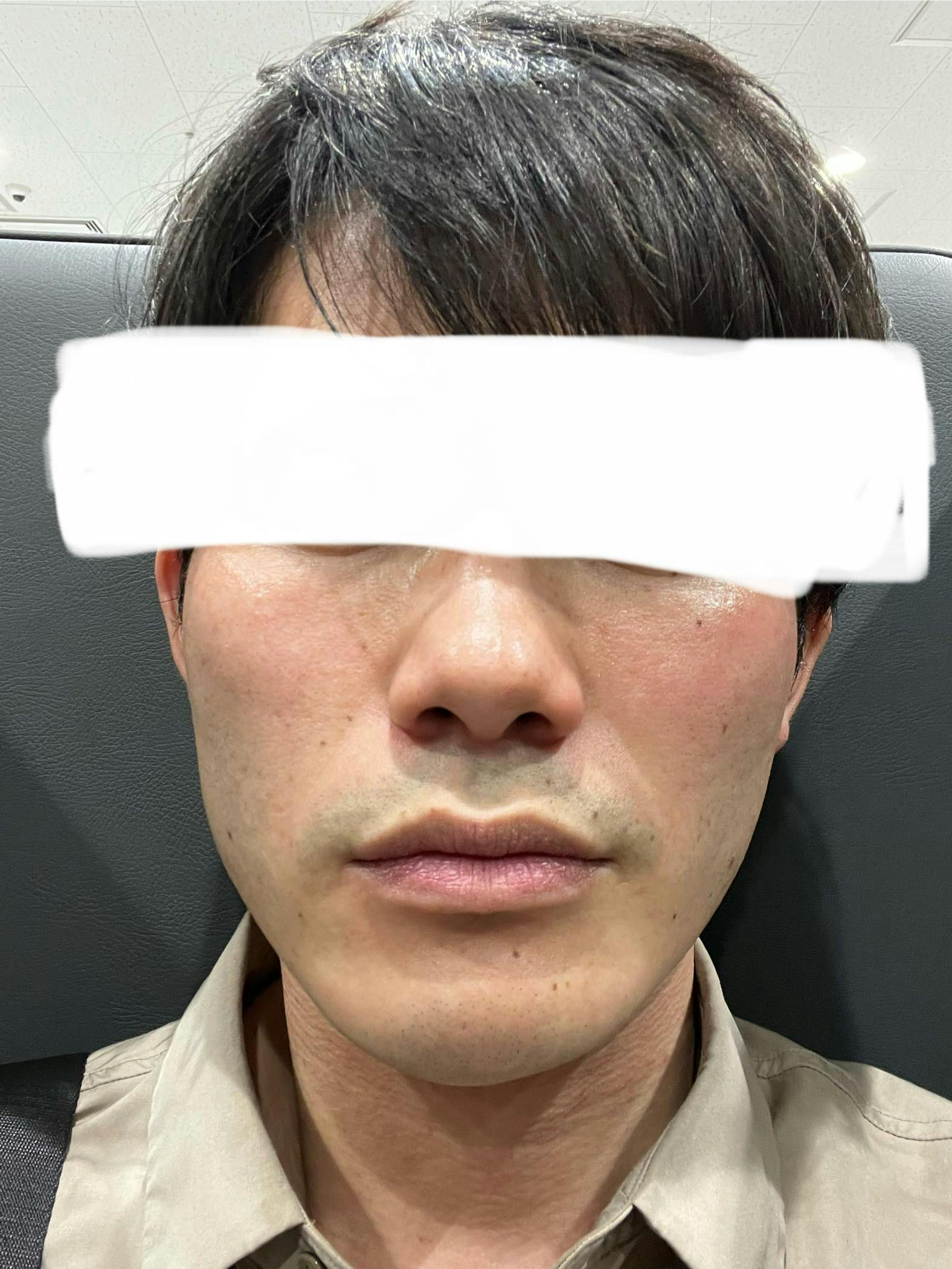 湘南美容クリニック 名古屋駅本院で顔脱毛を受けたひろちゃんさんの写真