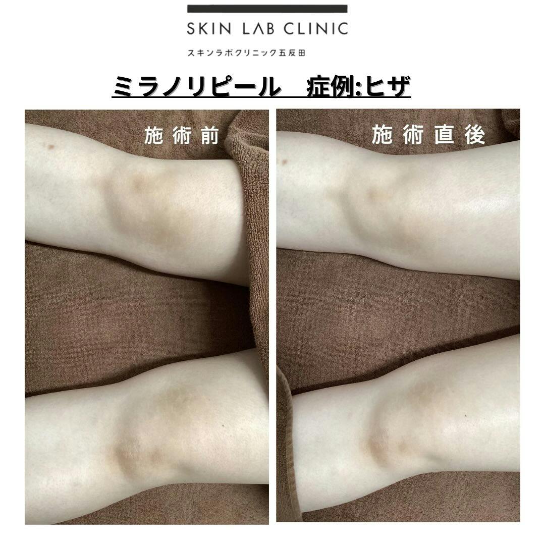 ミラノリピールができる美容クリニックの症例写真・ビフォーアフター