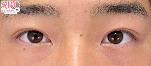 【10代男性・目元】クイックコスメティーク・ダブルNeo_after