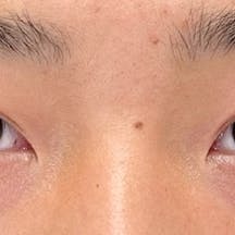 【10代男性・目元】クイックコスメティーク・ダブルNeo_after