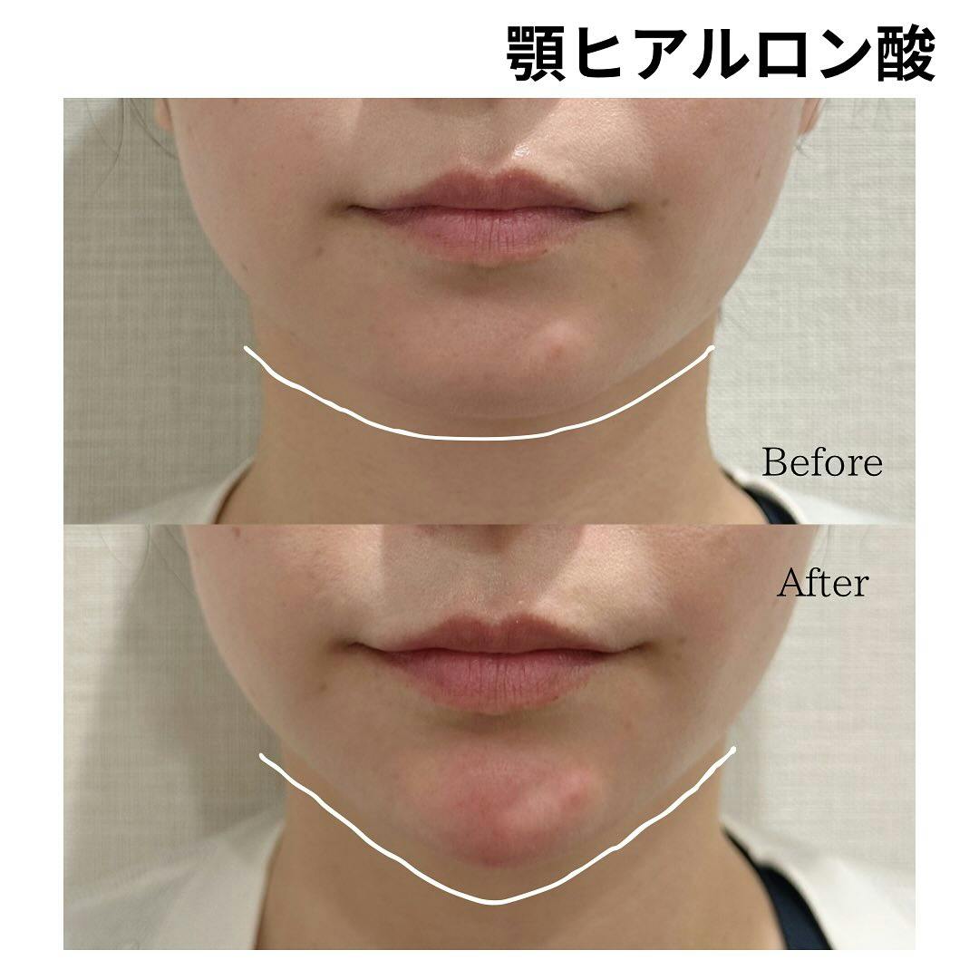 【女性・顎】ヒアルロン酸_before_aftar