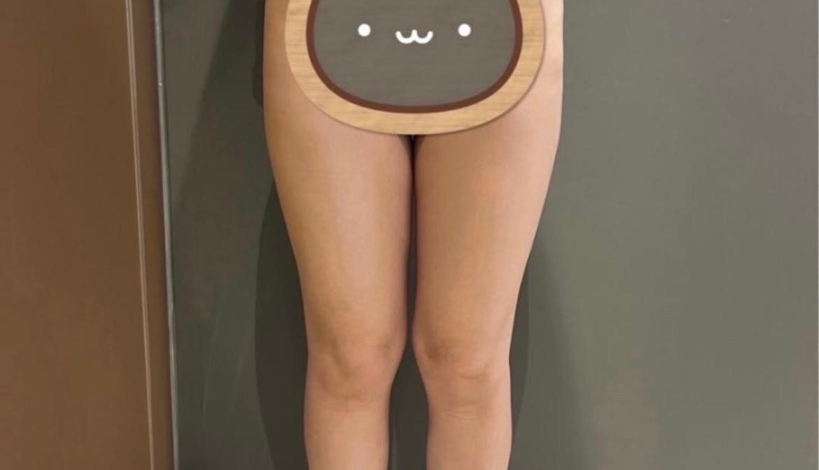 レアート整形外科で太もも脂肪吸引を受けたはなまるさんの写真