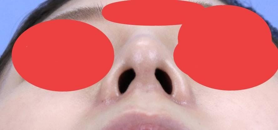 聖心美容クリニック 銀座院で鼻の整形：鼻孔縁下降術を受けたらんちさんの写真