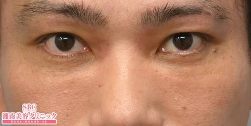 【40代男性・目元】目の下の切らないクマ・たるみ（ふくらみ）取り ナチュラル脂肪注射コンデンスリッチ ナチュラル脂肪注射ナノリッチ_after
