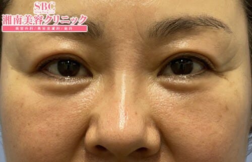 【女性・目元】ナチュラル脂肪注射コンデンスリッチ、ナチュラル脂肪注射ナノリッチ、目の下の切らないクマ・たるみ（ふくらみ）取り_aftar