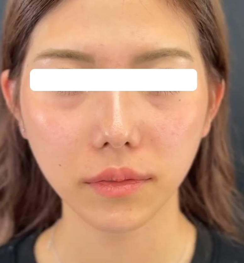 ルラ美容クリニック 大阪心斎橋院でヒアルロン酸注入：鼻翼基部ヒアルロン酸と上口唇ヒアルロン酸を受けたあやぴさんの写真