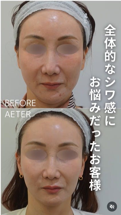 【50代女性・シワ】ピーリング・ハイフ・ボトックス・エルメス注射_before_aftar