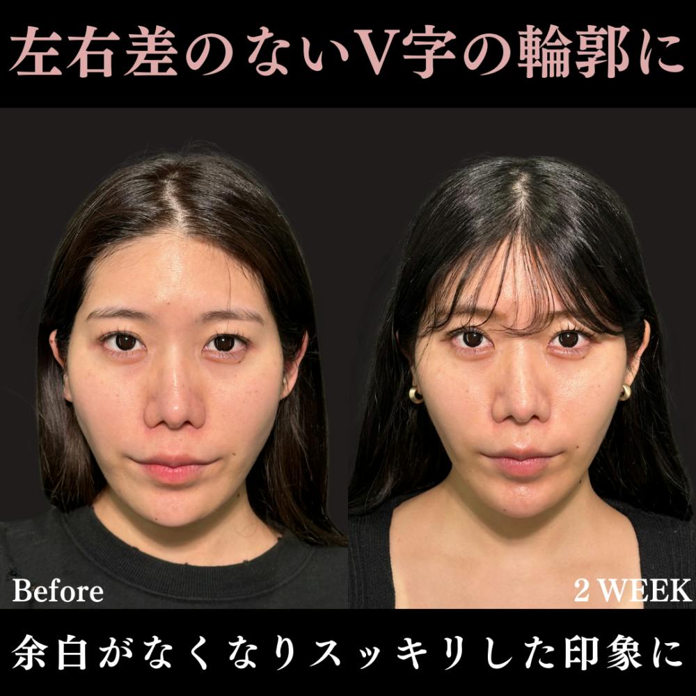 【20代女性・顔】糸リフト（アルテミスリフト10本）＋エラのボトックス注射_before_aftar