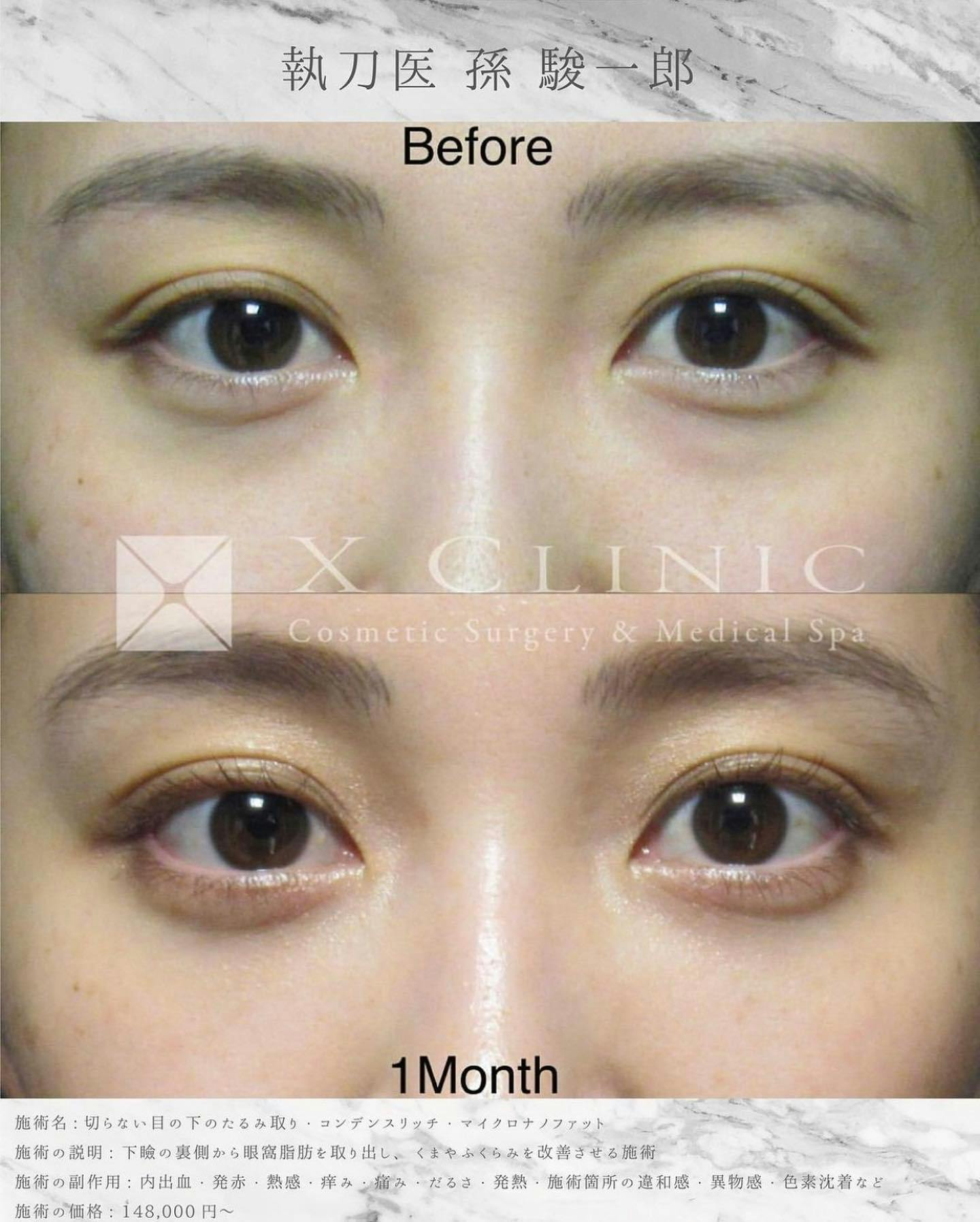 【女性・目元】クマ取りフルコース_before_aftar