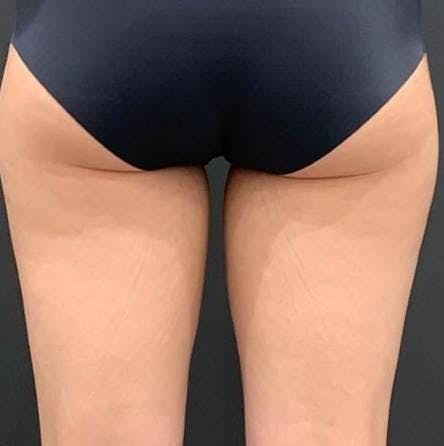 ワムクリニック銀座(WOM CLINIC GINZA)でボディ脂肪吸引：太もも 脂肪吸引を受けたYO～YOさんの写真