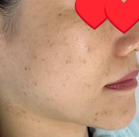 聖心美容クリニック 六本木院でしみを取る施術：しみ取りレーザーを受けたらっきーさんの写真