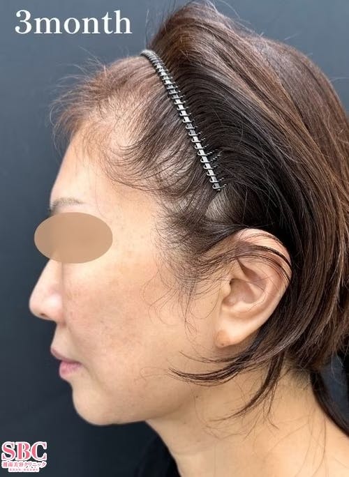 【50代女性・輪郭】美ボディ脂肪吸引_after