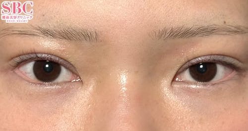 【20代女性・目元】線留めクロス二重術_justafter
