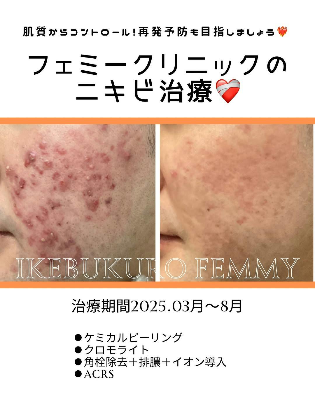 フェミークリニック 池袋院_before_aftar