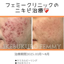 フェミークリニック 池袋院_before_aftar