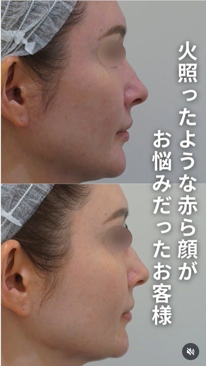 【女性・赤み】ケミカルピーリング ジェネシス ピコフラクショナル強 ALLONE_before_aftar