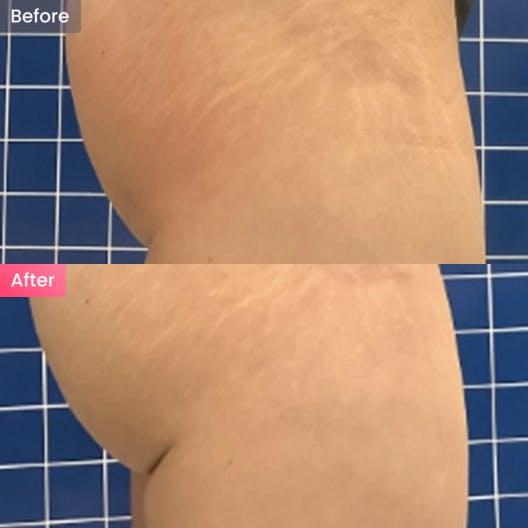 【脂肪】ヒップの脂肪減らしたいの写真