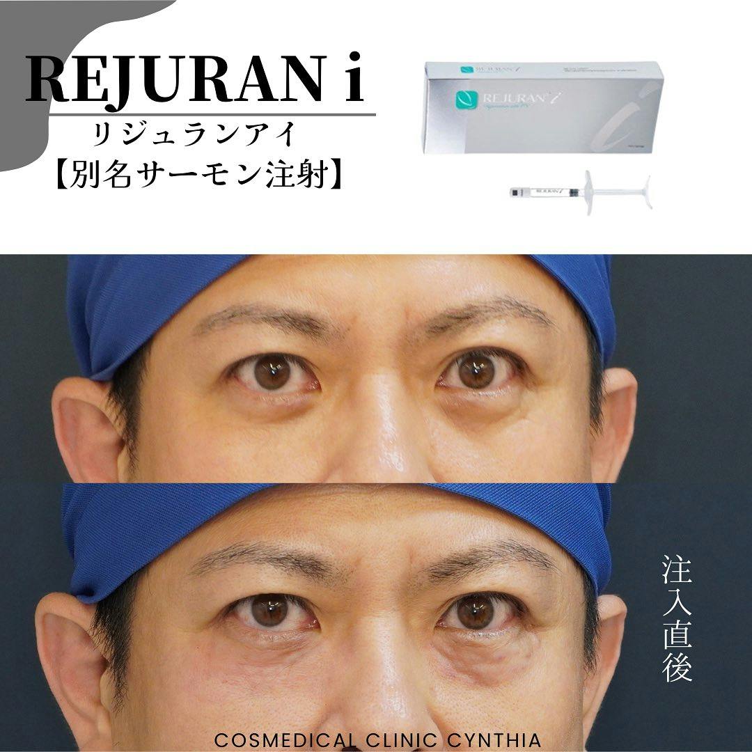 【男性・目元】リジュランi_before_aftar