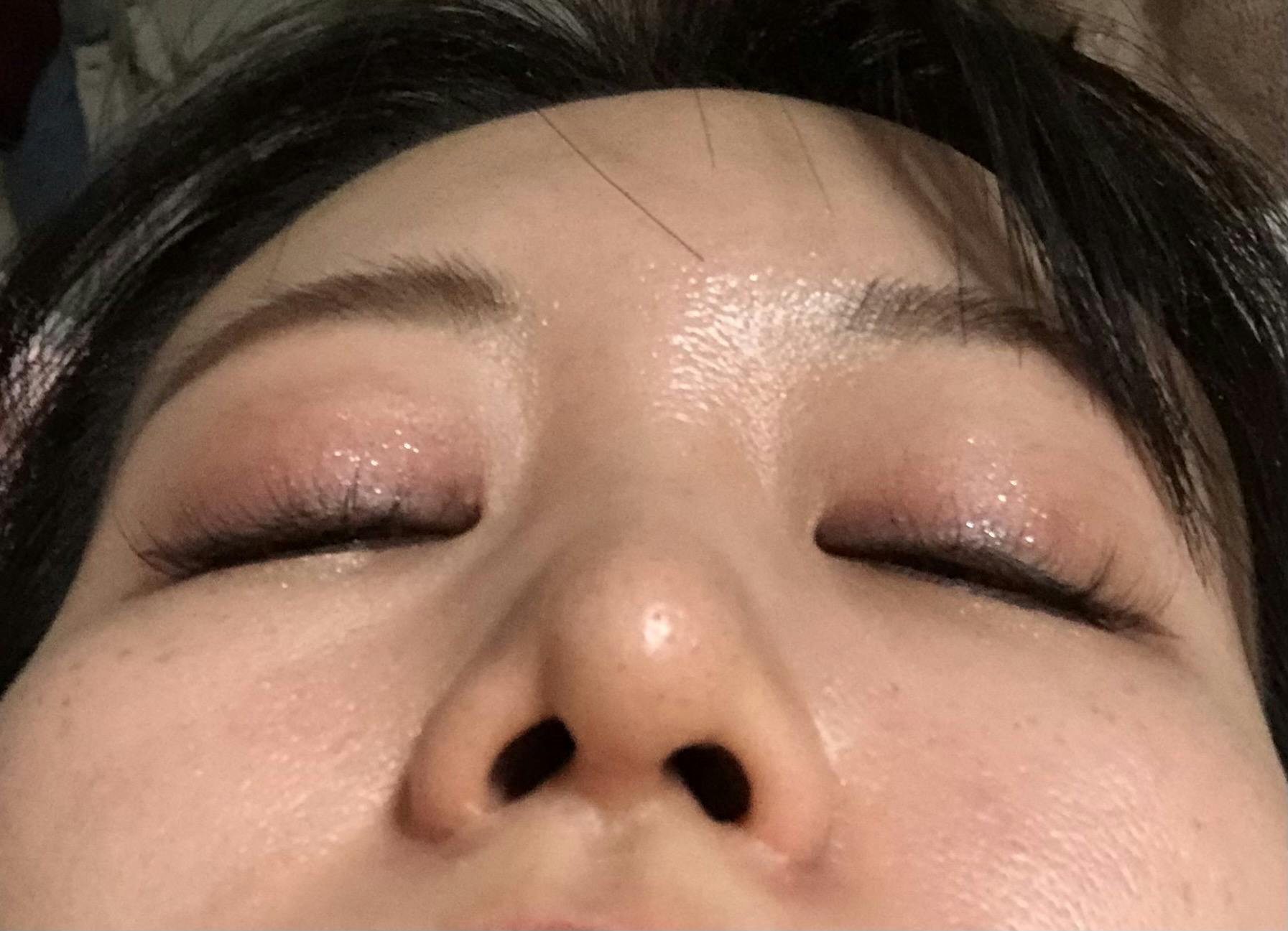 品川スキンクリニック宇都宮院（※品川美容外科提携）でを受けたSaki9991さんの写真