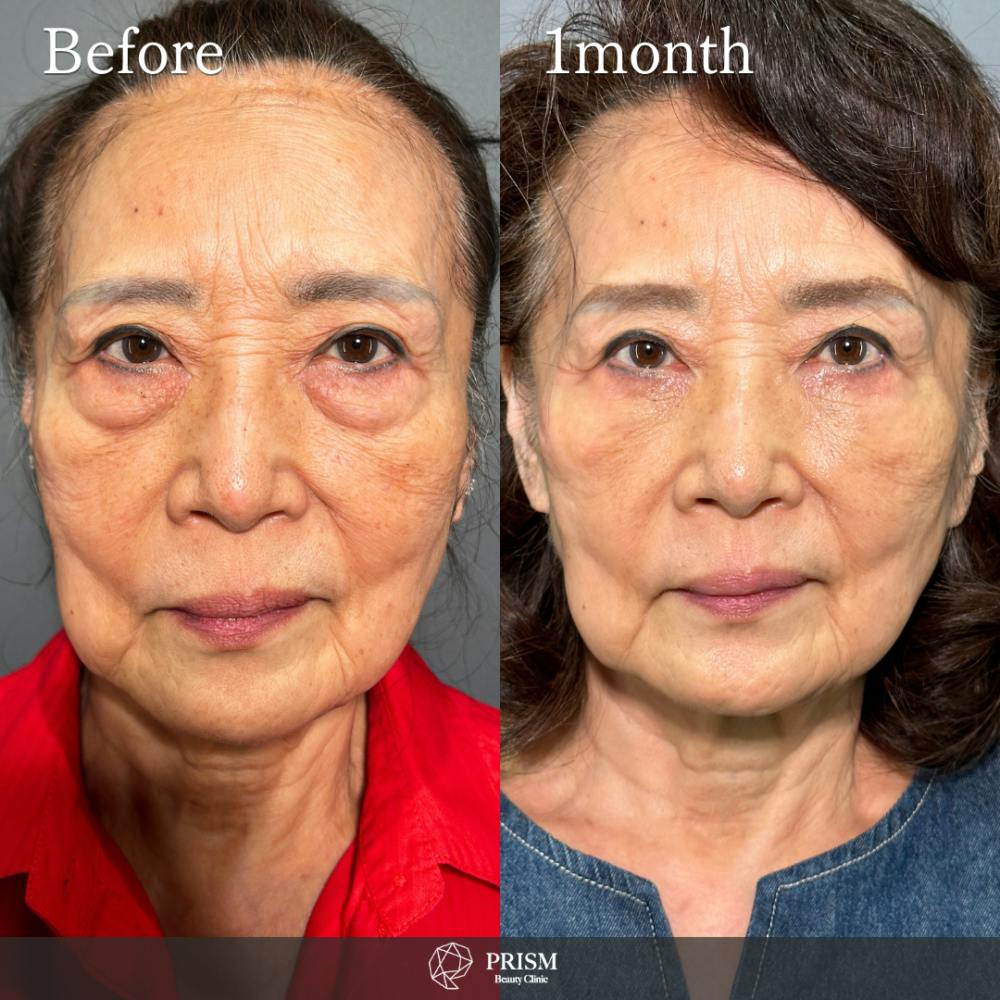 【70代女性・目】切らない目の下のクマ取り＋ヒアルロン酸（目の下）_before_aftar