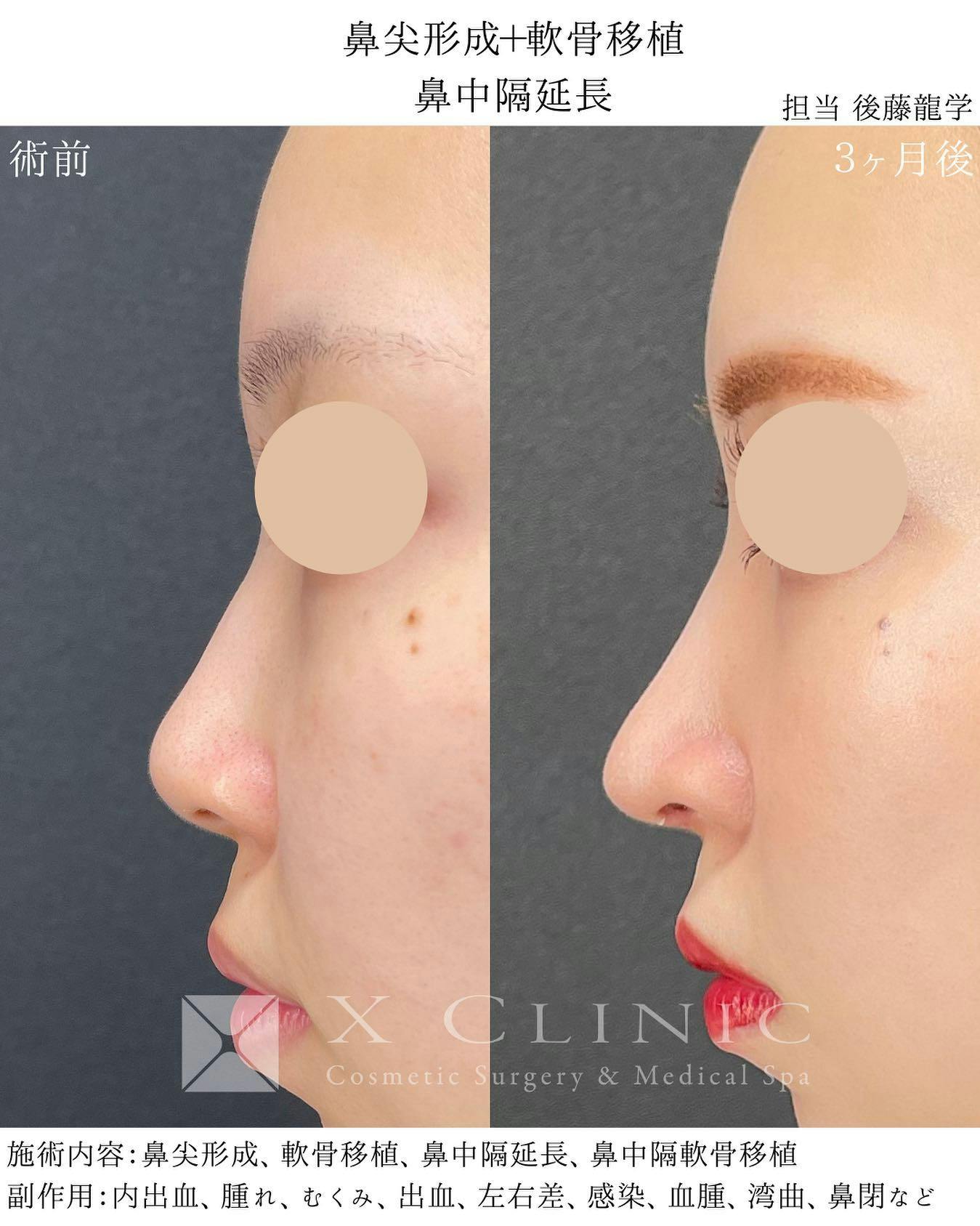 【女性・鼻】定額鼻整形（鼻尖形成、鼻中隔延長 (鼻中隔軟骨)、耳軟骨移植）_before_aftar