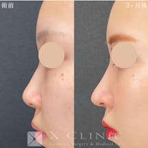 【女性・鼻】定額鼻整形(鼻尖形成、鼻中隔延長 (鼻中隔軟骨)、耳軟骨移植)_before_aftar