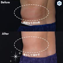 【男性・腹部】クールスカルプティング_before_aftar