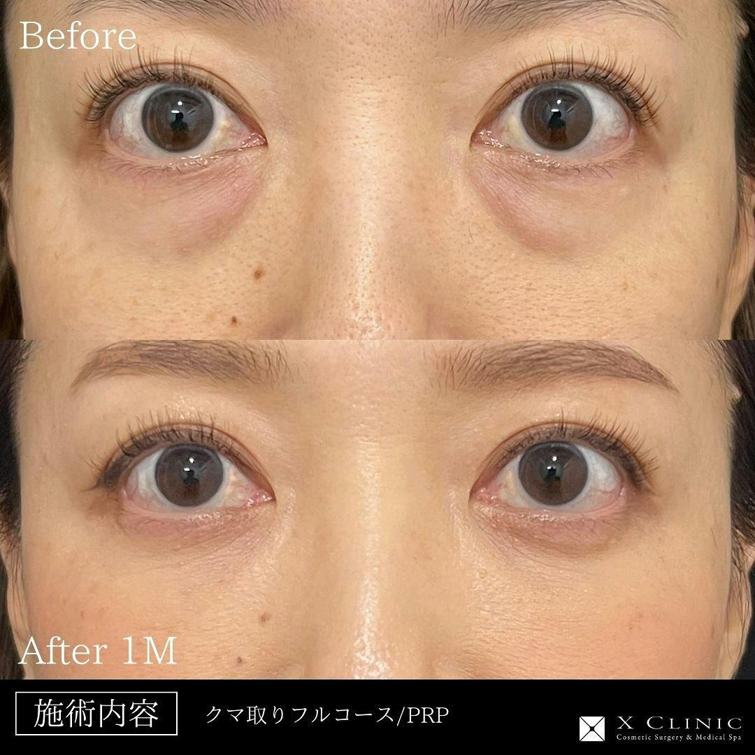 【女性・目元】クマ取りフルコース+PRP_before_aftar