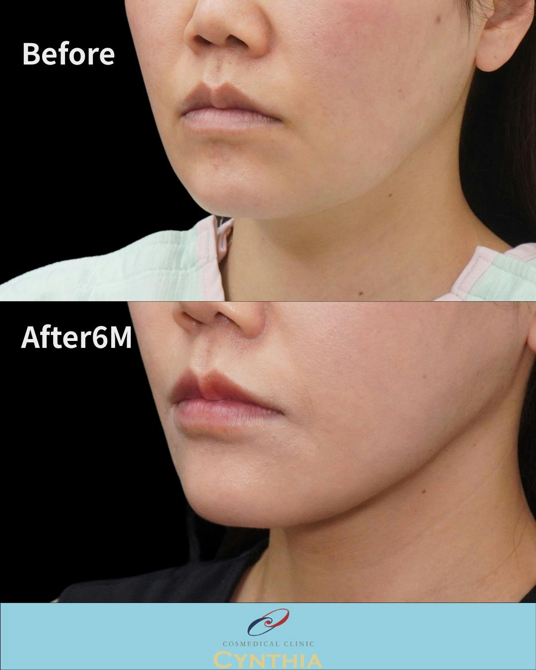 【41歳女性・輪郭】脂肪吸引_before_aftar