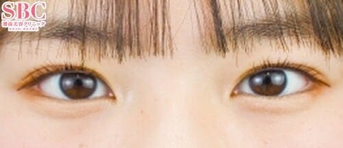 【10代女性・目元】クイックコスメティーク・ダブルNeo_after