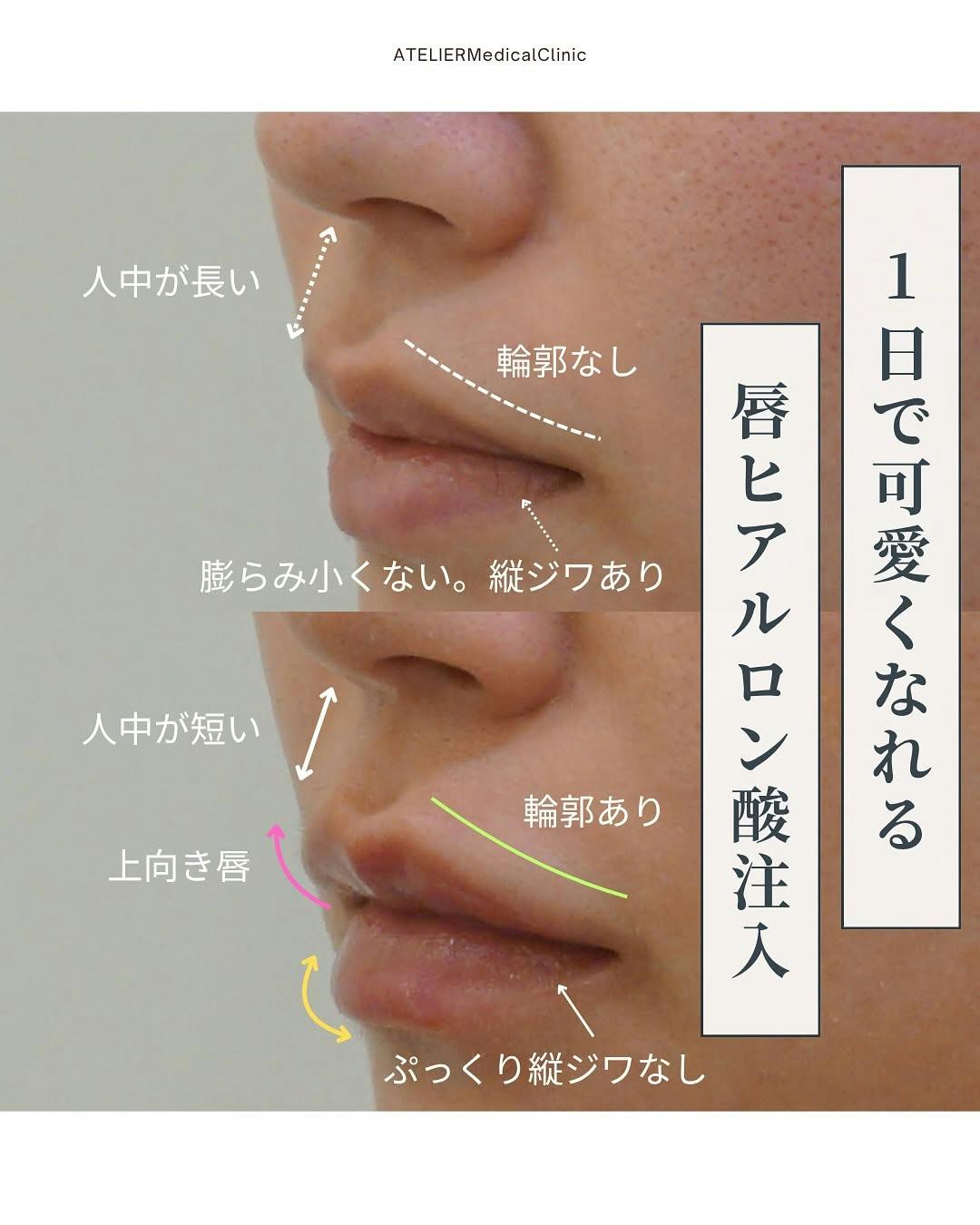 【女性・唇】唇ヒアル_before_aftar