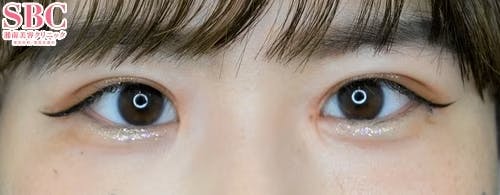 【20代女性・目元】週末二重(R)_after