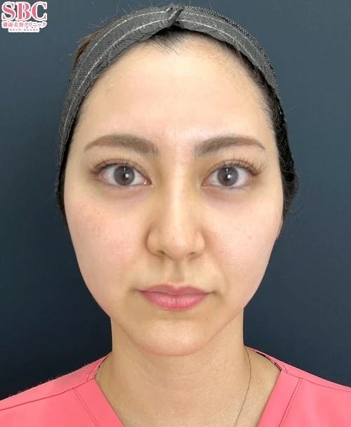 【女性・輪郭】VOV（ボブ）リフト_before