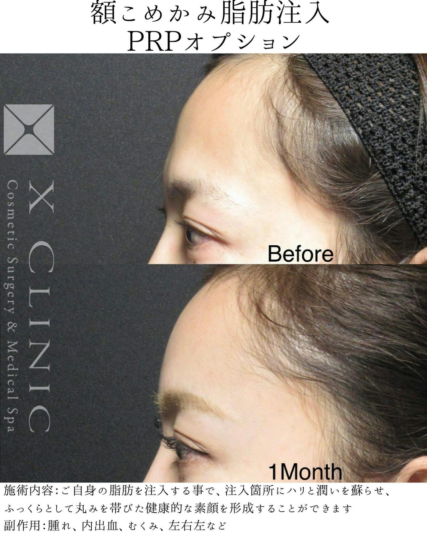 【女性・額】額こめかみ脂肪注入_before_aftar