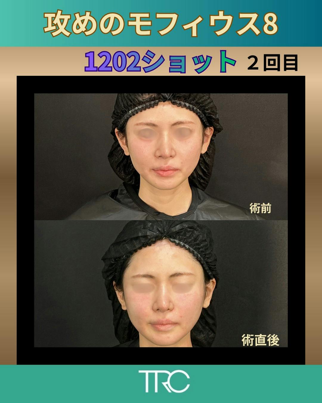 【女性・たるみ】攻めのモフィウス8_before_aftar