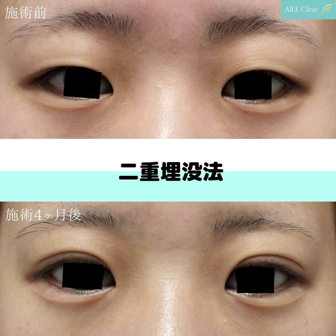 【女性・目元】二重埋没法_before_aftar