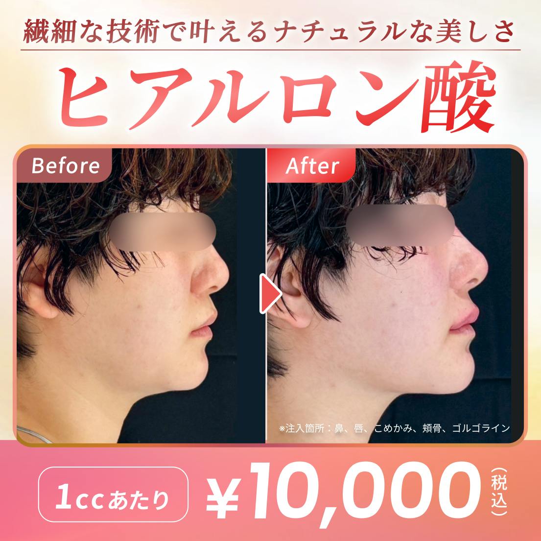 ❣️キレイレポ限定❣️ ヒアルロン酸 1cc~ | Dr.手打ちでふっくらかわいく👶の画像
