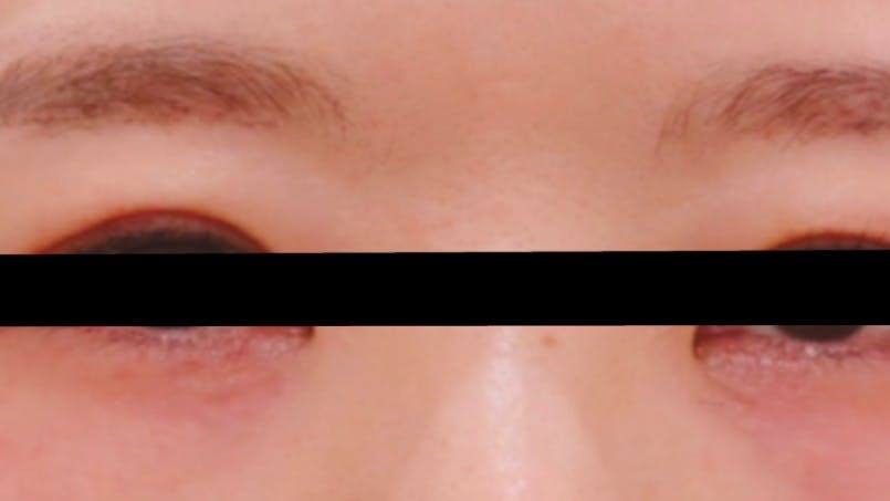 ワムクリニック銀座(WOM CLINIC GINZA)で目の下のくまとり　脱脂のみを受けたまろんさんの写真