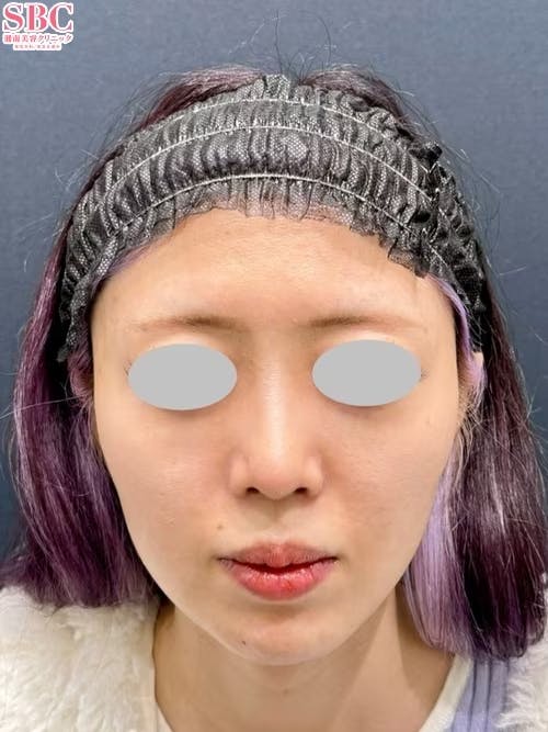 【20代女性・鼻】SBCプレミアムソフトプロテーゼ 鼻尖形成/鼻尖形成3D法（だんご鼻解消術） 鼻尖部軟骨移植_after