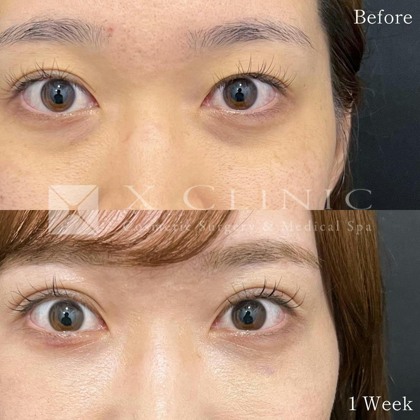 【20代女性・目元】Xクロストリプル＋クマ取りフルコース＋エクソソーム_before_aftar