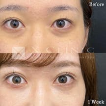 【20代女性・目元】Xクロストリプル+クマ取りフルコース+エクソソーム_before_aftar