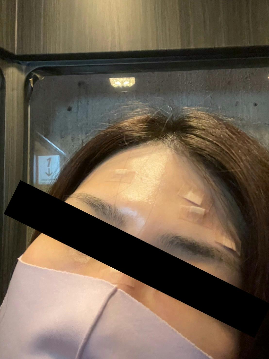 青山ヒフ科クリニックでを受けたかぼさんの写真