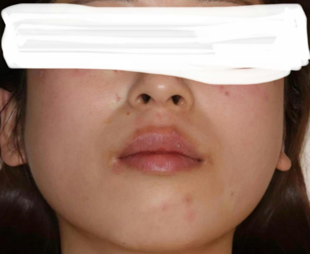 湘南美容クリニック 名古屋駅本院でレーザー医療脱毛を受けたひろにゃんさんの写真